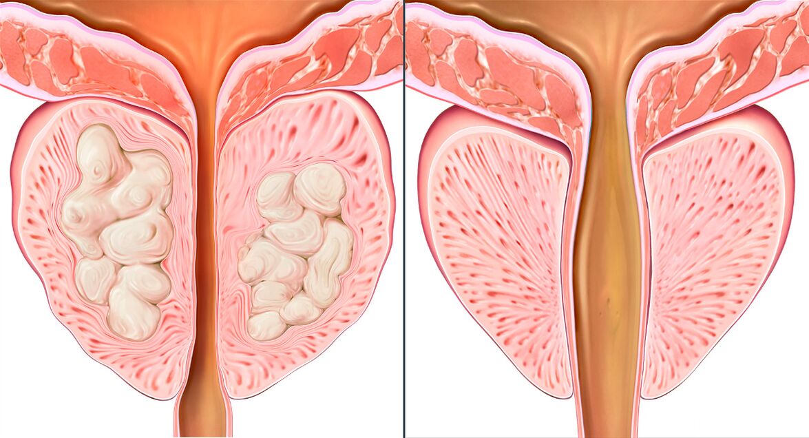 Stufen der Behandlung von Prostatitis mit Prostalix